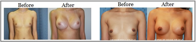 Placentia Breast enlargement