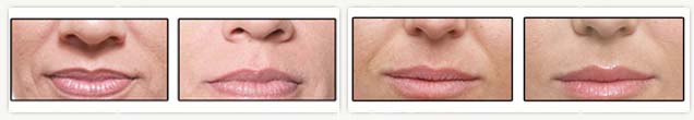 Juvederm photo
