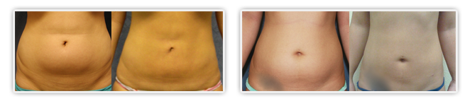 Liposuction Orange County clients Before & After Liposuction procedure by Dr Kalantarian