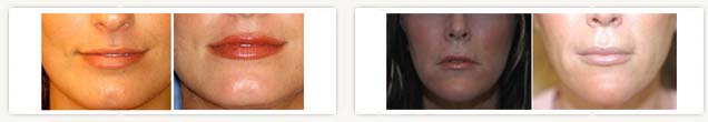 Restylane photo
