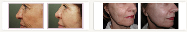 chemical peels