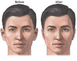 Villa Park Otoplasty