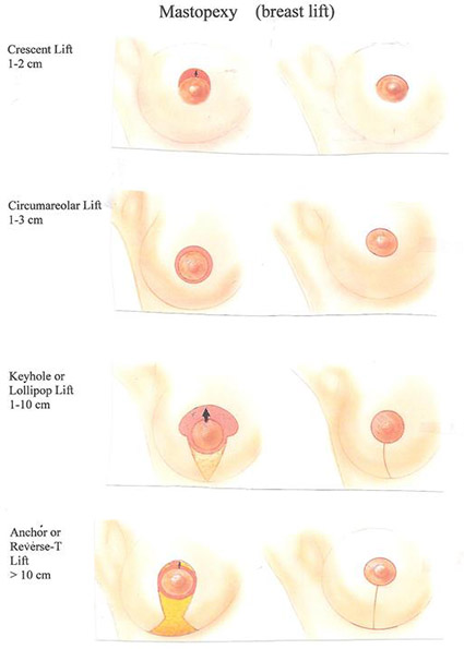 what are the different types of breast lifts?