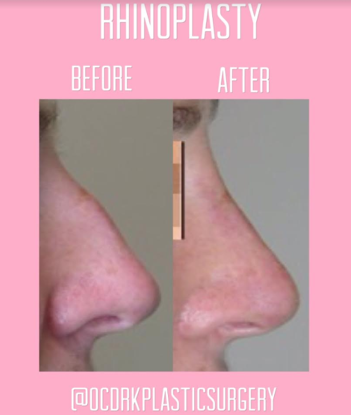 Rhinplasty before and after