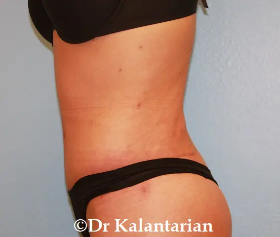 Tummy Tuck Before And After - Dr. Kalantarian Plastic Surgery