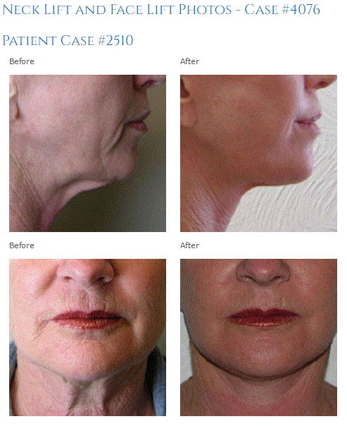 neck lift 