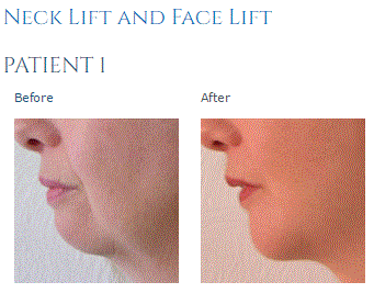 neck lift