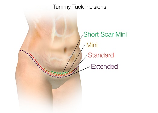 tummy tuck scar