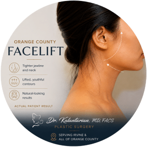 Actual facelift patient result by Dr. Kalantarian showing improved jawline, neck contour, and facial rejuvenation in Orange County.